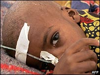 A child suffering from malnutrition is treated at a MSF centre in Tahoua, northern Niger